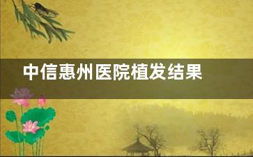 中信惠州医院植发结果实测!成活率高+价格合理,发友亲测自然度满分!