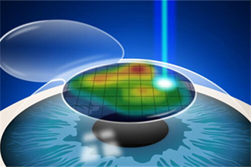 近视手术漫画示意图 近视手术漫画示意图