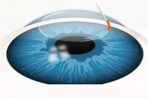 近视矫正眼球漫画示意图 近视矫正眼球漫画示意图