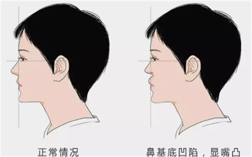 鼻基底凹陷对面部的影响图解