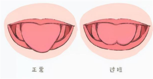 舌系带过短与正常舌头对比