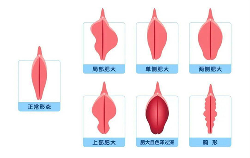 正常阴唇形态和阴唇肥大对比动画图