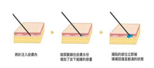 注射玻尿酸的原理 注射玻尿酸的原理