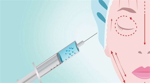 注射玻尿酸示意图 注射玻尿酸示意图
