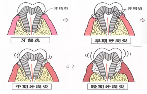 牙龈炎不同程度卡通图