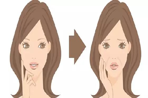 面部出现法令纹前后对比示意图