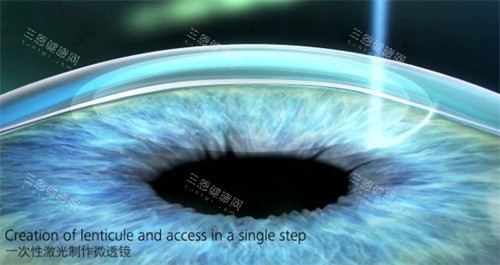 激光手术示意图