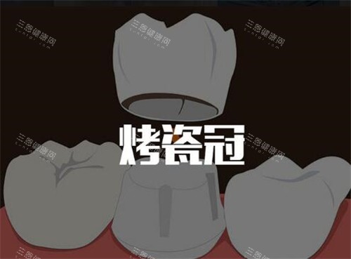 烤瓷牙改善图照片