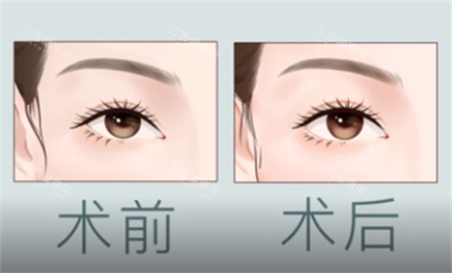 开外眼角术前术后对比