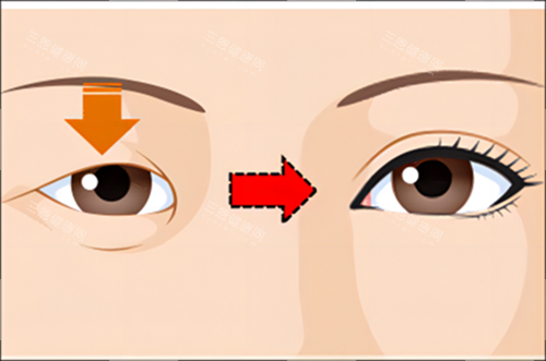 单眼皮变双眼皮对比示例图