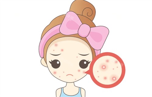 面部痘痘 面部痘痘