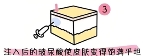 玻尿酸填充原理 玻尿酸填充原理