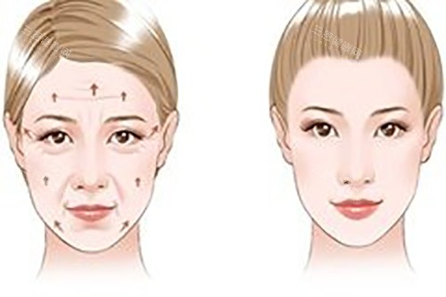 玻尿酸美容外观图 玻尿酸美容外观图