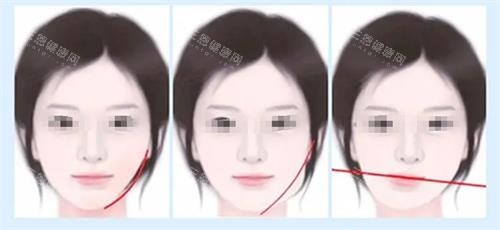 面部不对称的类型 面部不对称的类型