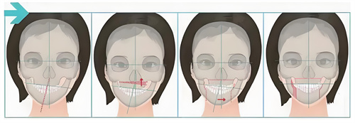 正颌手术手术步骤展示动画图 正颌手术手术步骤展示动画图