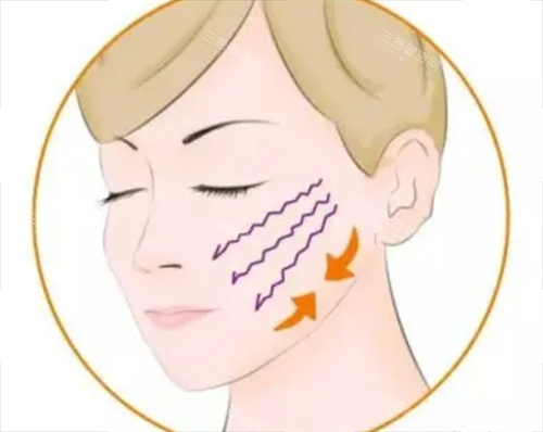 埋线提升修复面部凹陷 埋线提升修复面部凹陷