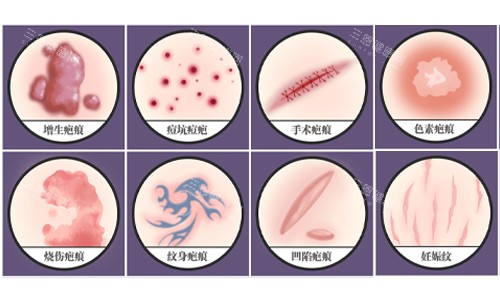 疤痕的种类展示 疤痕的种类展示