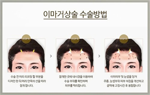 拉皮内窥镜手术步骤示例图 拉皮内窥镜手术步骤示例图