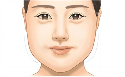 脸颊脂肪过多图片 脸颊脂肪过多图片