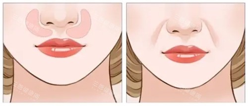 口周老化对面部影响 口周老化对面部影响