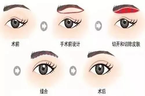 眉切法示意图 眉切法示意图