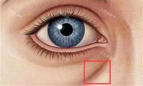 泪沟凹陷明显图 泪沟凹陷明显图