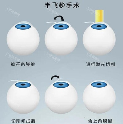 半飞秒手术卡通图