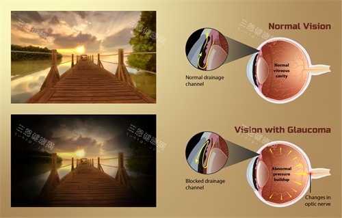 青光眼动画图示 青光眼动画图示