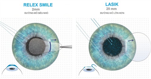 全飞秒跟半飞秒对比 全飞秒跟半飞秒对比