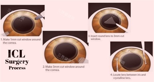 晶体植入手术过程细节图 晶体植入手术过程细节图