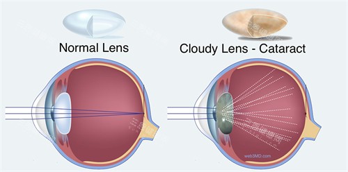 白内障图示 白内障图示