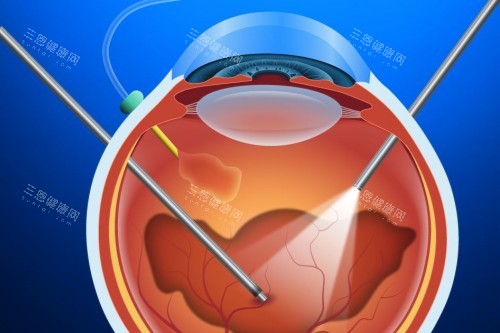 玻璃体切除术 玻璃体切除术
