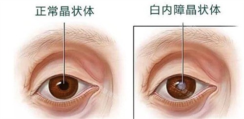 正常晶状体和白内障晶状体 正常晶状体和白内障晶状体