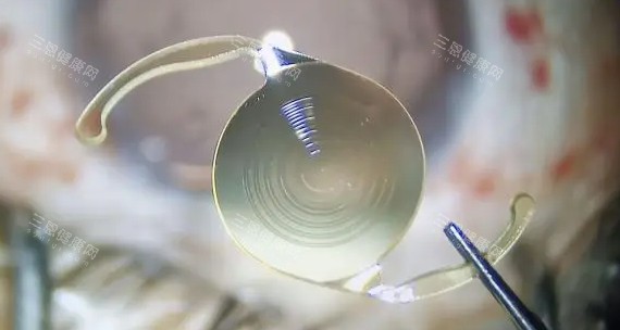 三焦点人工晶体 三焦点人工晶体