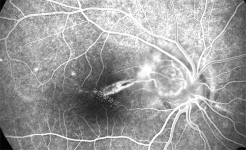 眼底病变 眼底病变