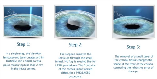 眼睛近视手术的过程 眼睛近视手术的过程