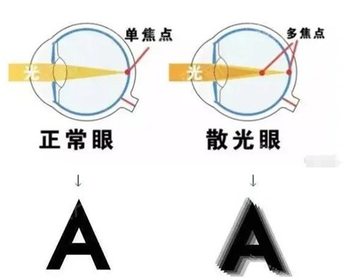 正常眼和散光眼的对比