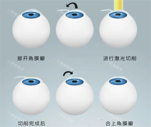 半飞秒手术过程