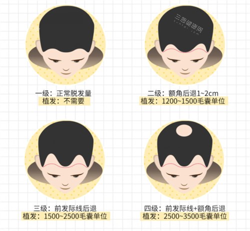 脱发等级展示