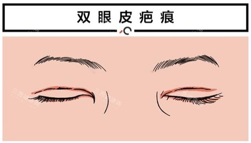 双眼皮疤痕图示
