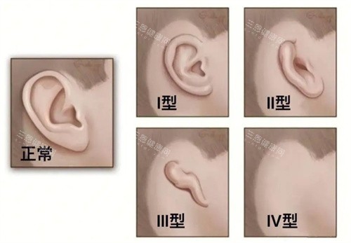 耳畸形的种类