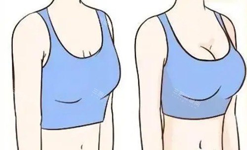 胸部整形前后对比卡通示意图 胸部整形前后对比卡通示意图