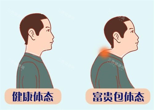 健康体态和富贵包体态的区别 健康体态和富贵包体态的区别