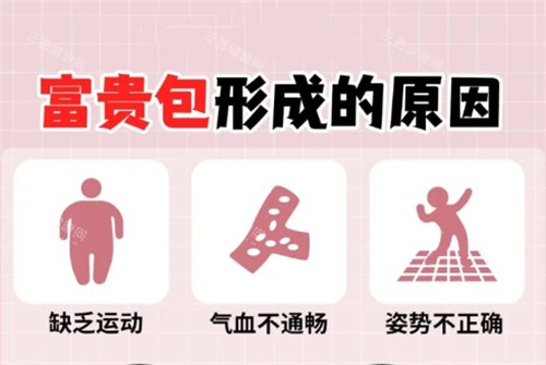 富贵包形成的原因 富贵包形成的原因