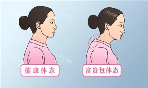 有无富贵包对比 有无富贵包对比