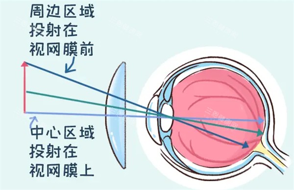 离焦软镜矫正原理图解