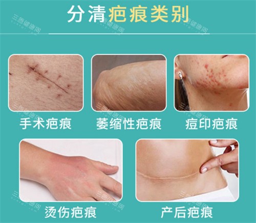 疤痕的类别
