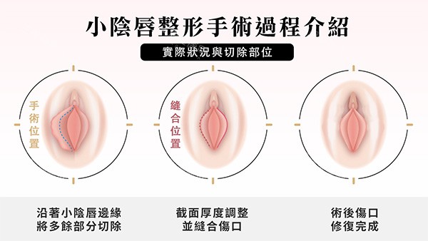 阴唇一边长一边短改善照片