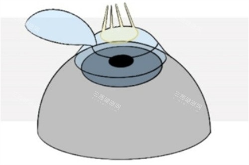 Refractive-Surgery-Techniques-1024x493_副本2