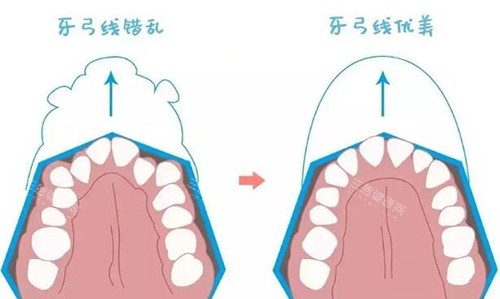 牙弓线错乱展示图